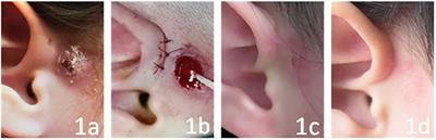 Summary of the Experience in the Diagnosis and Treatment of Complex Preauricular Fistulas in 78 Children